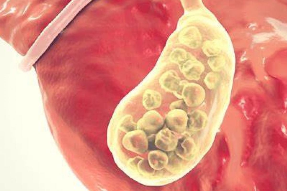 How Long Can a Gallbladder Stay Inflamed?