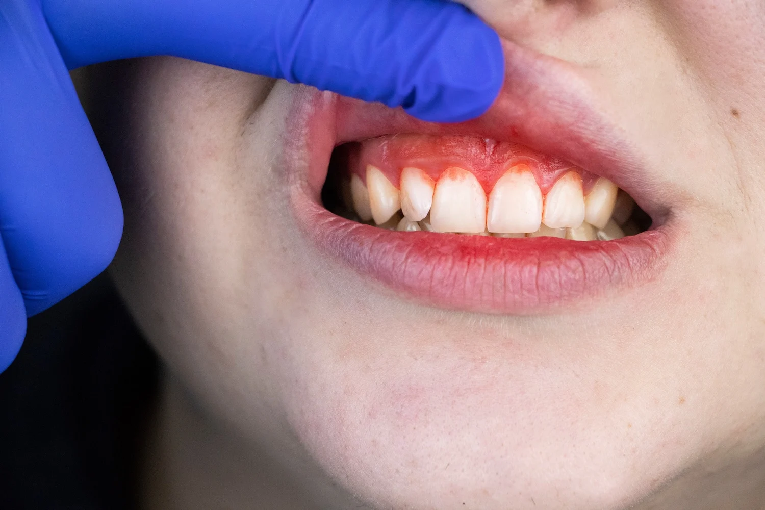 Is Gum Disease Contagious?