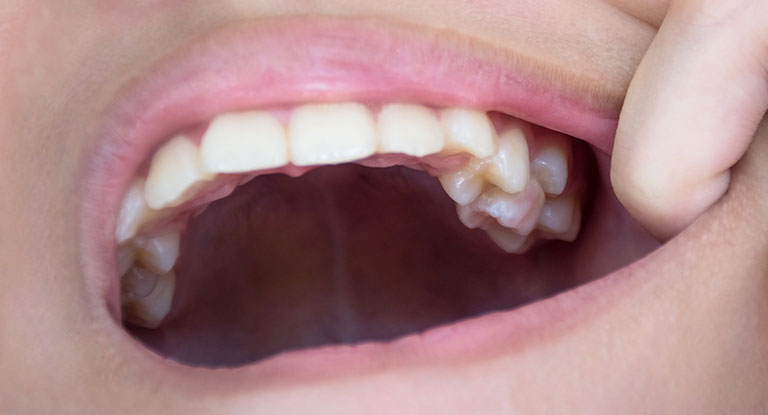 Signs Your Teeth Are Falling Out