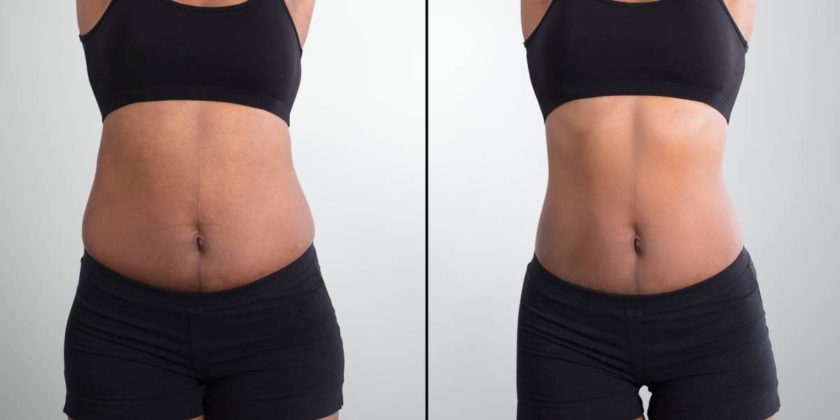 Uneven Weight Gain After Liposuction